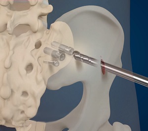 Minimally Invasive Sacroiliac Joint Fusion
