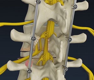 Minimally Invasive TLIF Houston | Lumbar Pain | Thoracic