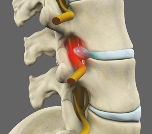 Radiculopathy