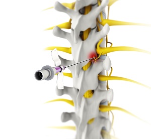 Sacroiliac Joint Radiofrequency Ablation