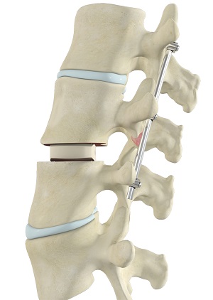 Transforaminal Lumbar Interbody Fusion (TLIF)