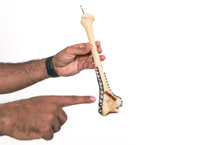 Distal Humerus Fractures of the Elbow - Gallery Pic 3