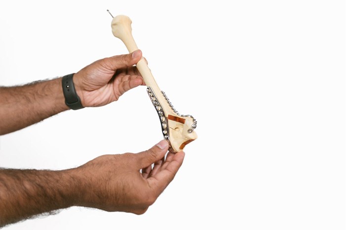 Distal Humerus Fractures of the Elbow - Gallery Pic 4