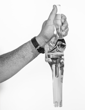 Total Knee Replacement - Gallery Pic 2