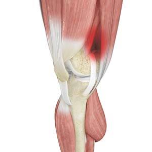 Iliotibial Band Syndrome1