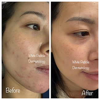 Platelet-Rich Plasma (PRP) pic