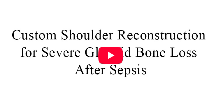 Custom Shoulder Reconstruction After Severe Glenoid Bone Loss and Sepsis | Video Testimonials | Patient Testimonials