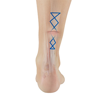 Picture of Achilles Tendon Repair