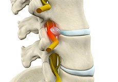 Picture of Lumbar Radiculopathy