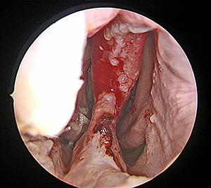 Septal Perforation 1- Perforation as presented