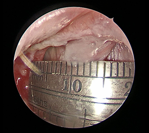 Septal Perforation 2 - Size of Perforation