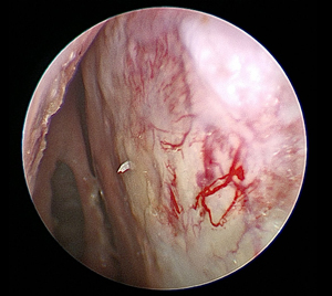 Septal Perforation 3 - Healed result