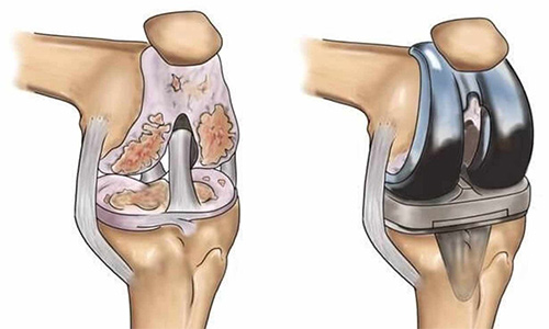 Picture of Knee Replacement