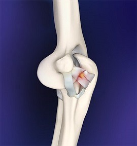 Elbow Ligament Reconstruction pic