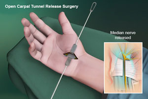 Minimally Invasive Hand and Wrist Surgery
