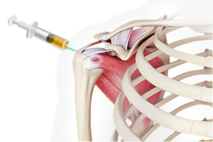Platelet-Rich Plasma (PRP) for the Shoulder