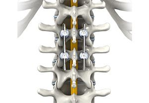 Endoscopic Spinal Fusion Sp