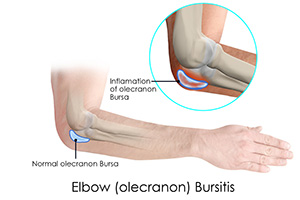 Elbow Bursitis