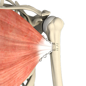 Pectoralis Major Muscle