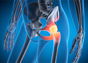 Comparing Direct Anterior and Posterior Hip Replacement: Where Robotic Assistance Fits In
