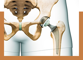 Direct Anterior Hip Replacement: Why a Muscle-Sparing Approach Matters