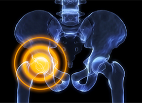From Imaging to Implant: How Robotic Planning Improves Hip Replacement Precision