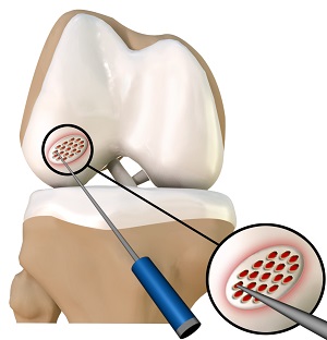 Cartilage Microfracture pic