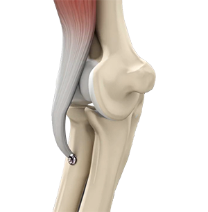 Img-Pelvic Fractures