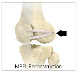 Img-Medial Patellofemoral Ligament Reconstruction