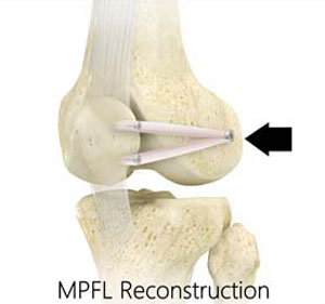 Medial Patellofemoral Ligament Reconstruction pic