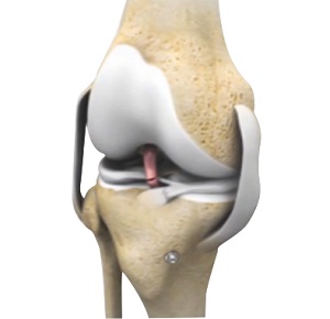 Img-Revision Knee Ligament Reconstruction