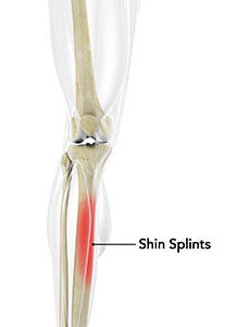 Shin Splints pic