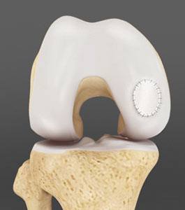 Cartilage Repair and Transplantation img