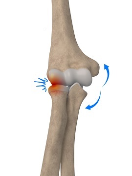 Lateral Impingement of the Elbow img