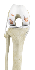 Osteoarthritis img