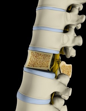 Osteoporosis img