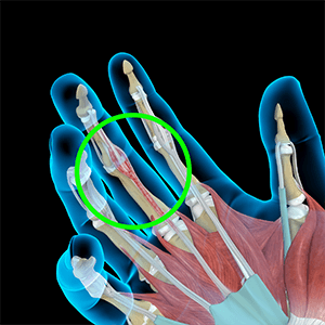 Tendonitis img