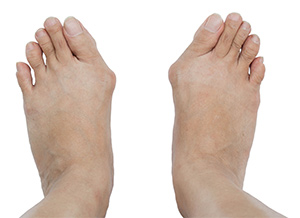 Foot and Ankle Arthritis