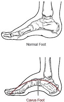 Cavus Foot Deformity Sp