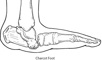 Cavus Foot Deformity Sp