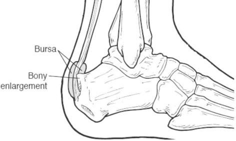 Cavus Foot Deformity Sp