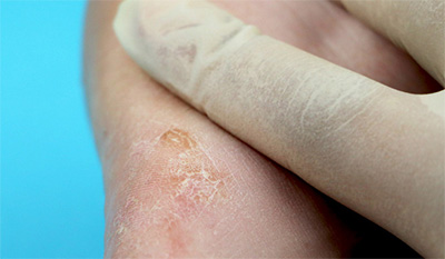 Epidermal Inclusion Cyst Sp