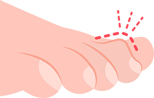 Conservative Treatment of Hammertoes