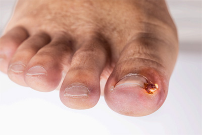 Ingrown Toenail Sp