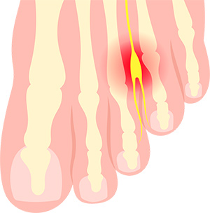 Neuroma