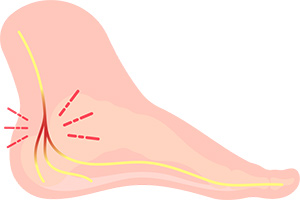Symptoms of Tarsal Tunnel Syndrome