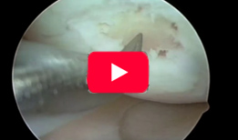 Treatment of Cartilage Defects