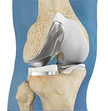 Oxford Unicompartmental Knee Replacement pic