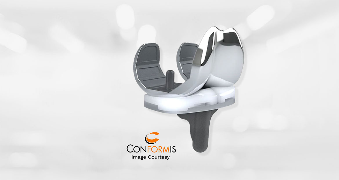 Conformis Knee SystemLatest Technology