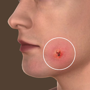 picture of Actinic Keratosis